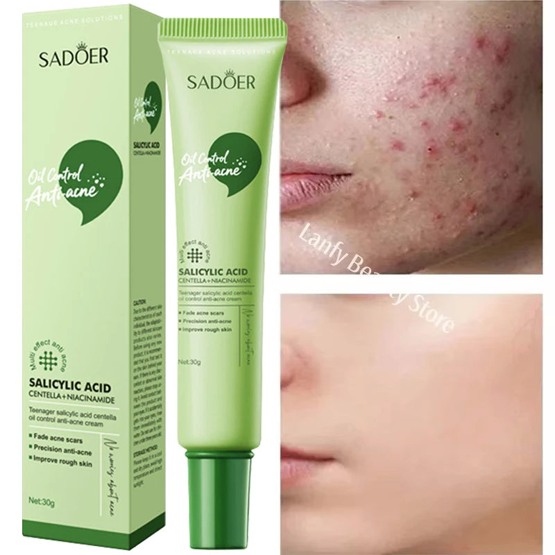 Salicylic Acid Acne Treatment Face Cream Repair Pimple Spots Deep Cleaning Pore Anti-acne Scar Oil Control Moisturizer Skin Care