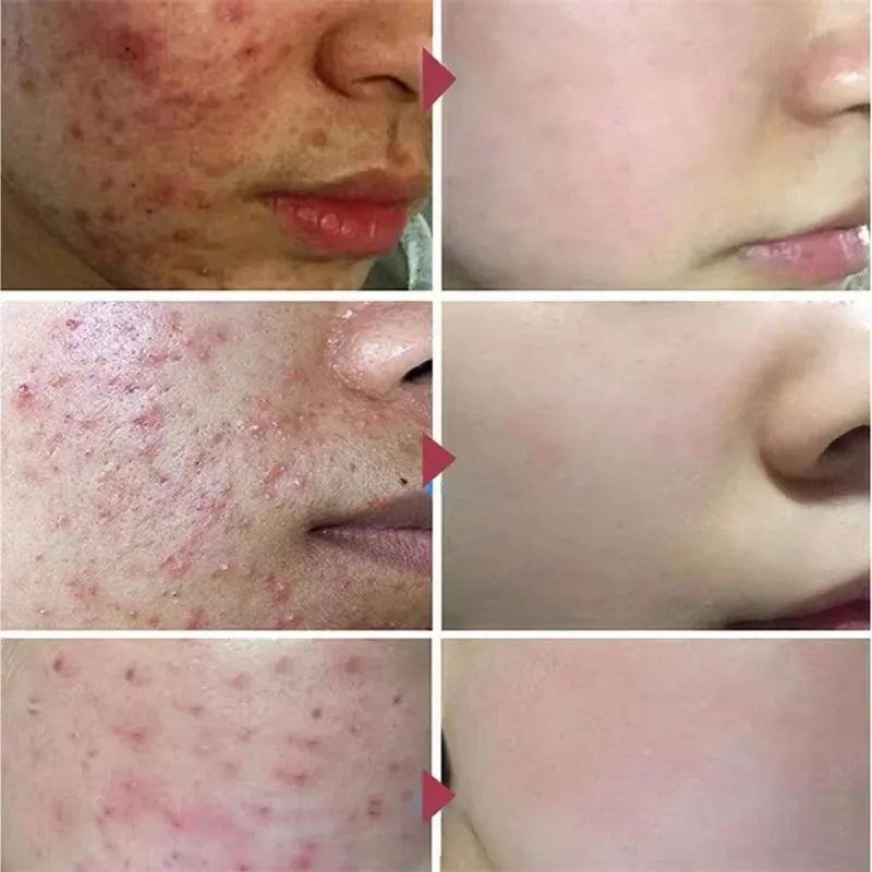 Salicylic Acid Acne Treatment Face Cream Repair Pimple Spots Deep Cleaning Pore Anti-acne Scar Oil Control Moisturizer Skin Care