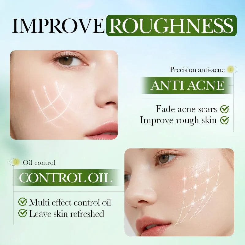 Salicylic Acid Acne Treatment Face Cream Repair Pimple Spots Deep Cleaning Pore Anti-acne Scar Oil Control Moisturizer Skin Care