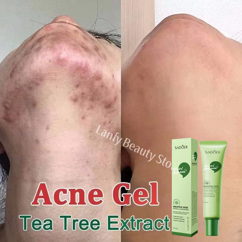 Salicylic Acid Acne Treatment Face Cream Repair Pimple Spots Deep Cleaning Pore Anti-acne Scar Oil Control Moisturizer Skin Care
